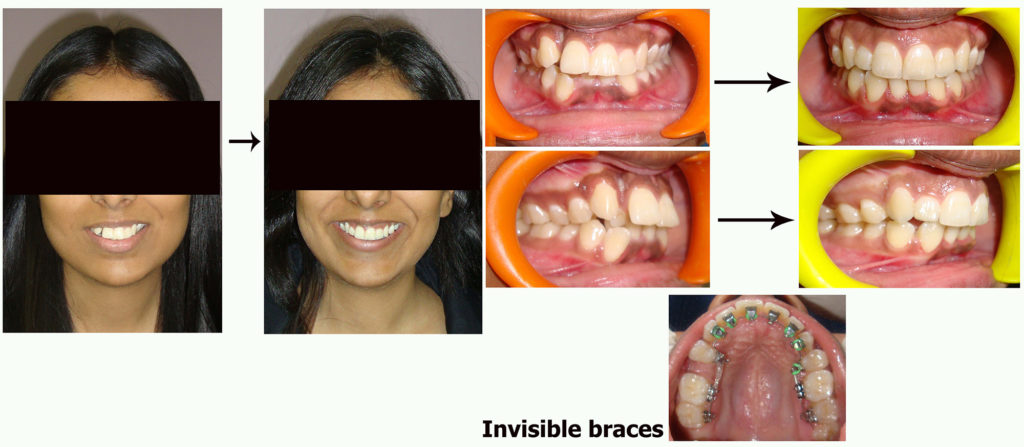 invisible braces cheap