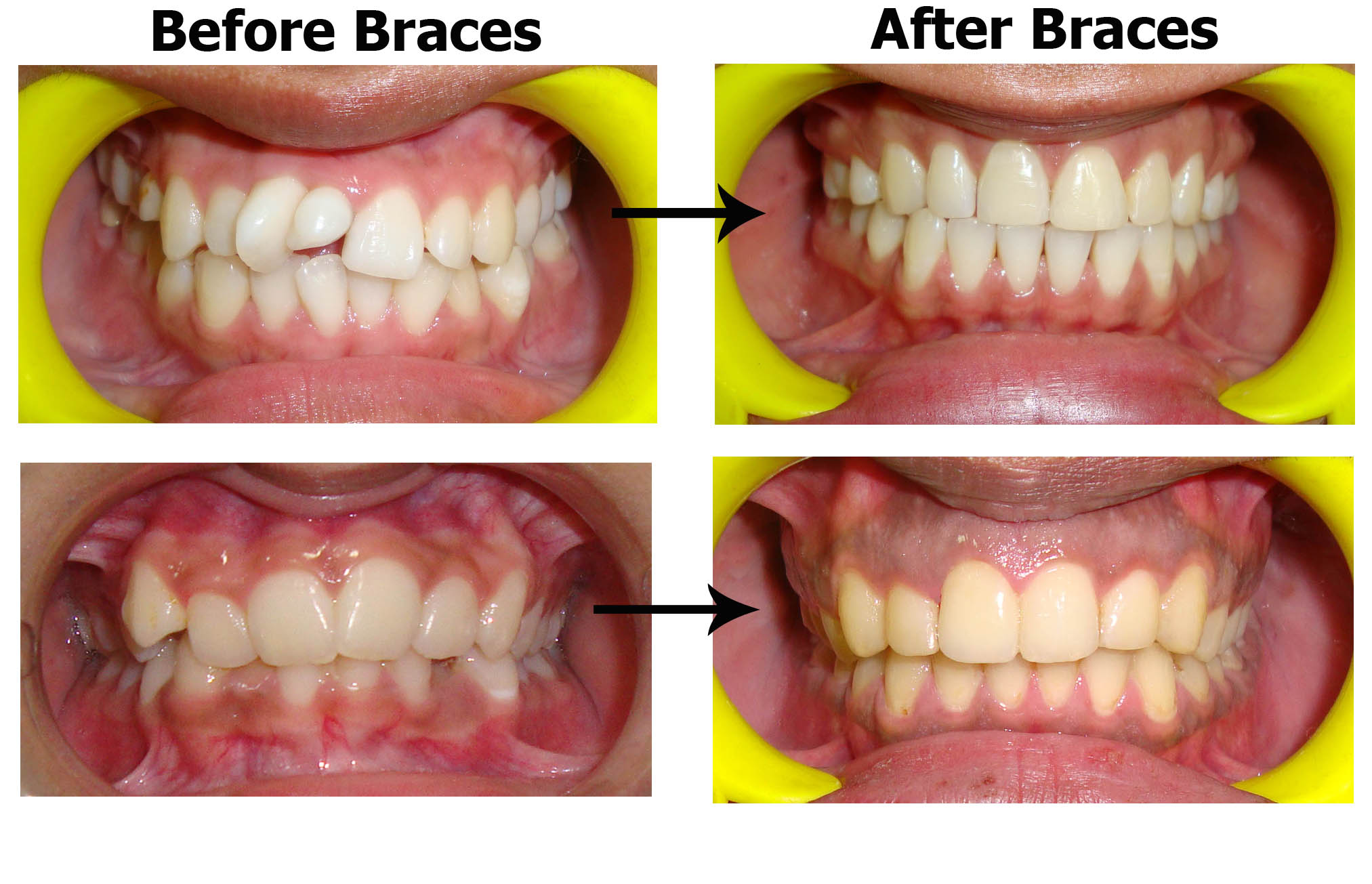 Best Dentist In South Delhi For Braces | Dental Treatment Braces ...